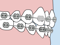 Loose bracket