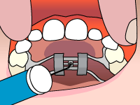 mappesortho palatal expander