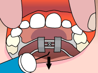 mappesortho palatal expander